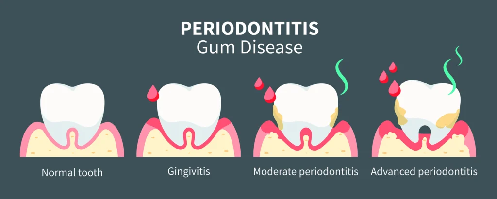 Close-up of a dental examination highlighting the importance of checking for gum disease. Schedule your exam with Rim Point Dental to maintain healthy gums.