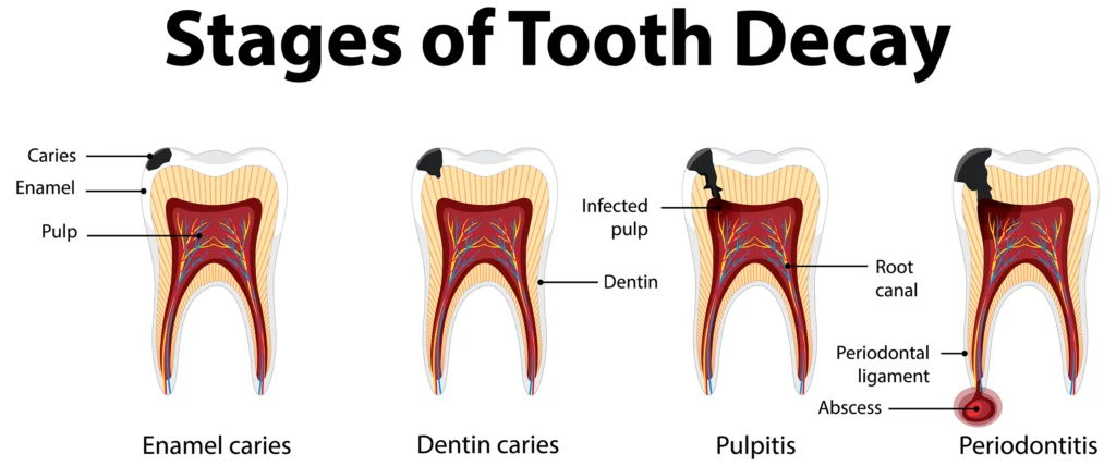 Illustration showing the stages of tooth decay, from enamel caries to periodontitis, highlighting the progression of cavities and tooth decay. Rim Point Dental educates patients on preventing these dental issues for optimal oral health.